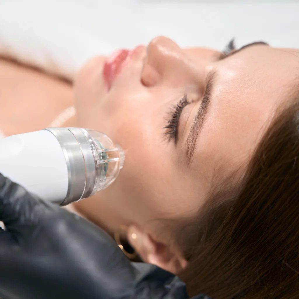 Microneedling Facial at Beautiful U Med Spa in American Fork, UT