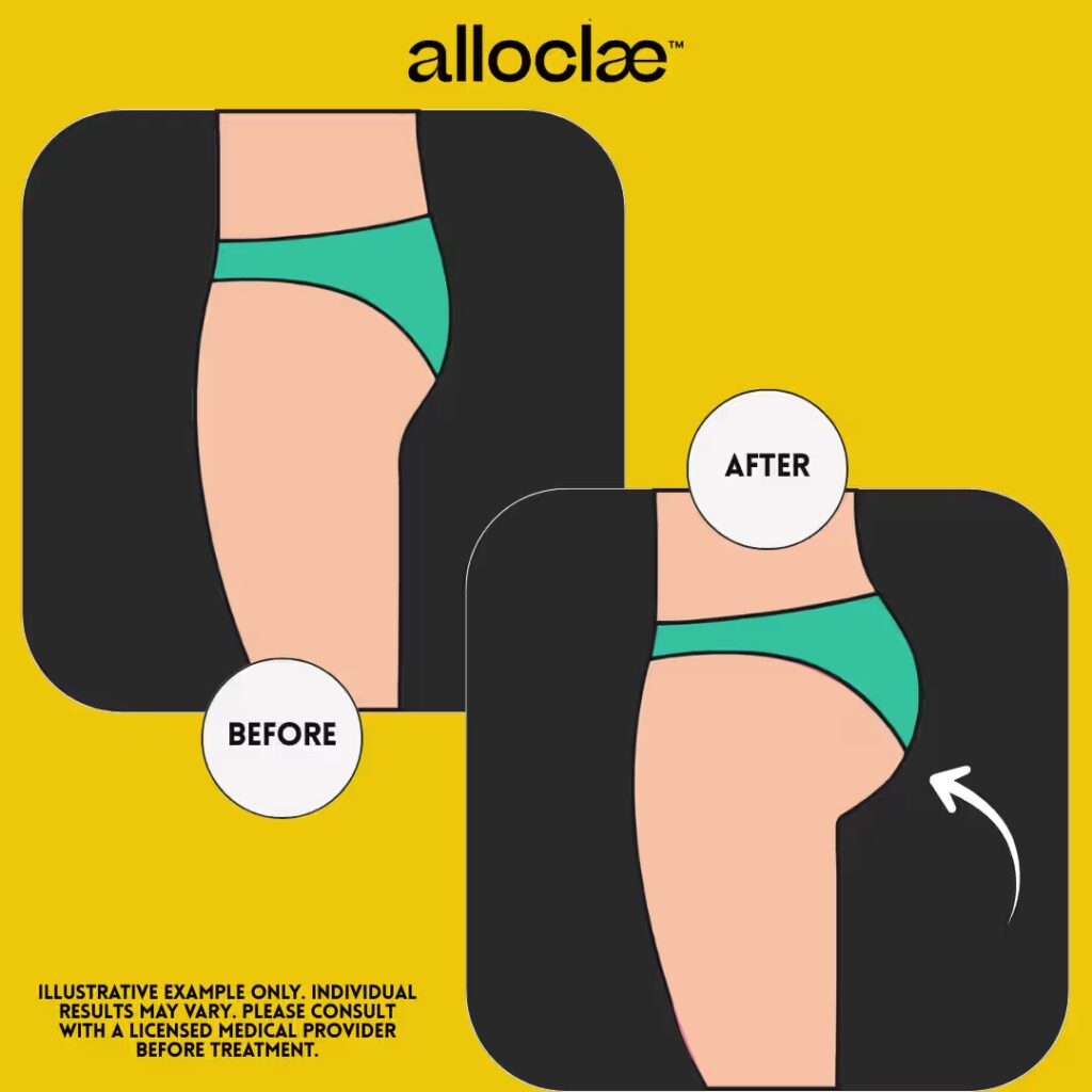 AlloClae™ | Regenerative Structural Adipose Filler
