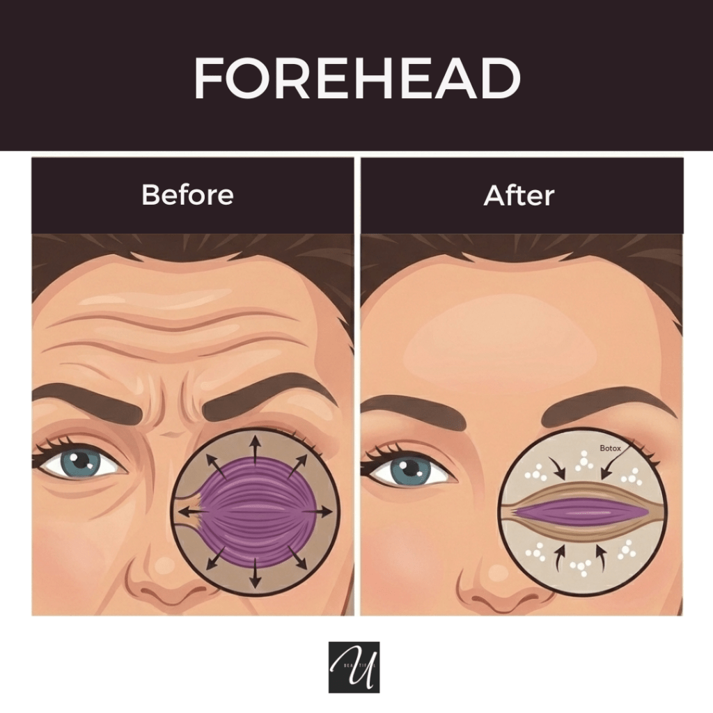 Graphic showing botox treating the forehead