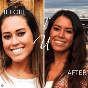 lip-flip-before-and-after-smile-gummy-smile-correction-american-fork