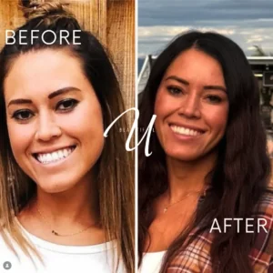 lip-flip-before-and-after-smile-gummy-smile-correction-american-fork