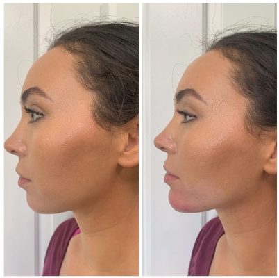 Before and After Jawline Filler