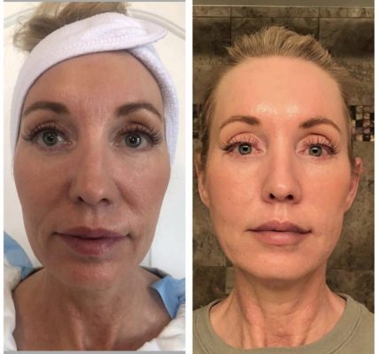 PDO Facial Threads In Utah, No Surgical Facelift